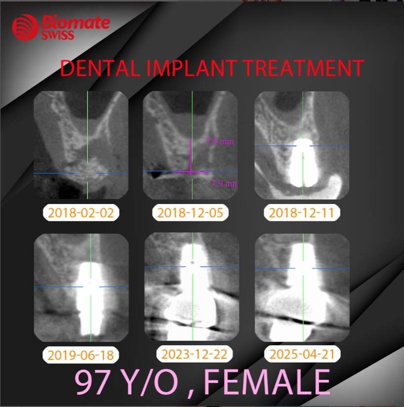 90歲奶奶植牙追蹤
