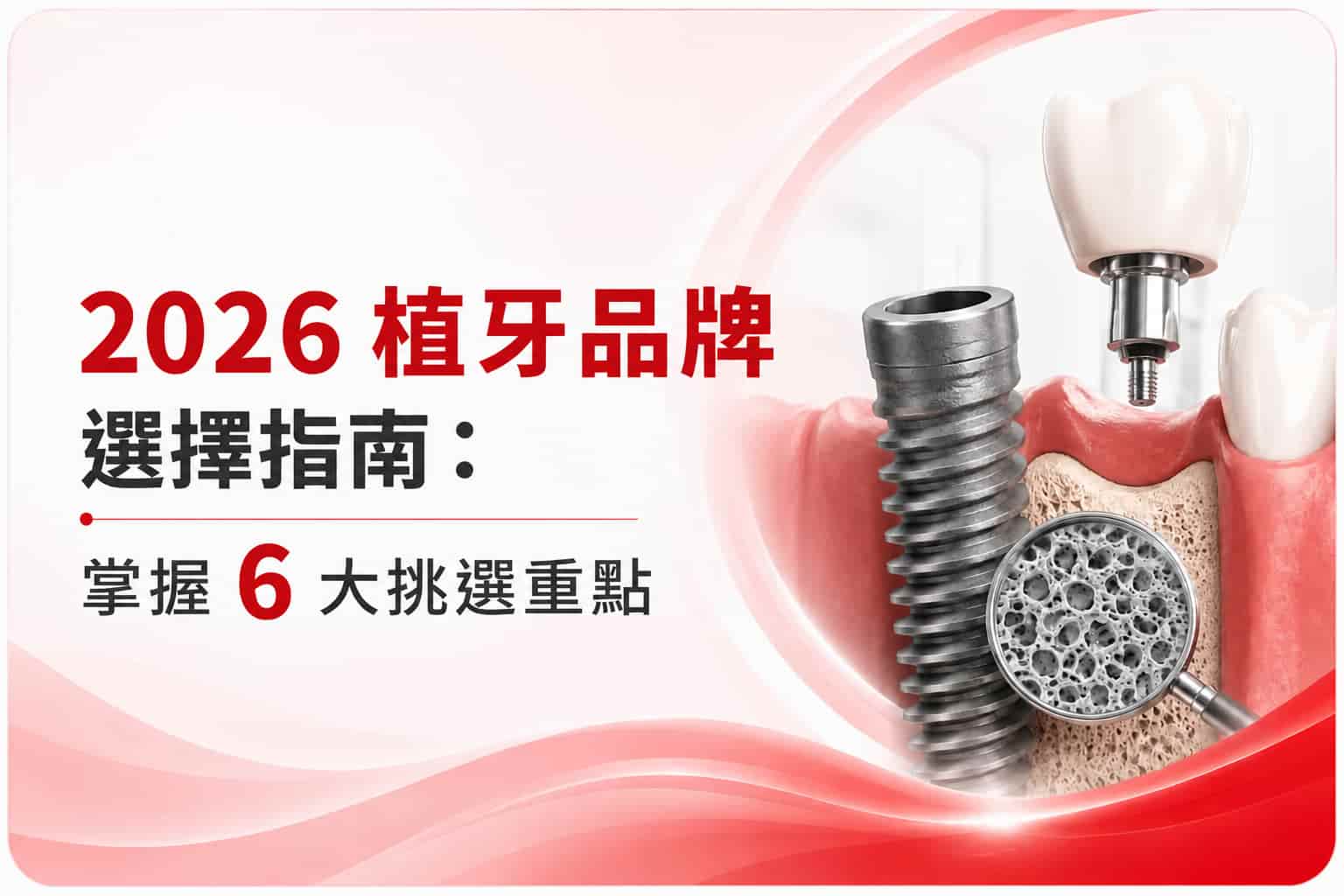 2026 植牙品牌選擇指南:掌握 6 大挑選重點 2026 植牙品牌選擇指南:掌握 6 大挑選重點